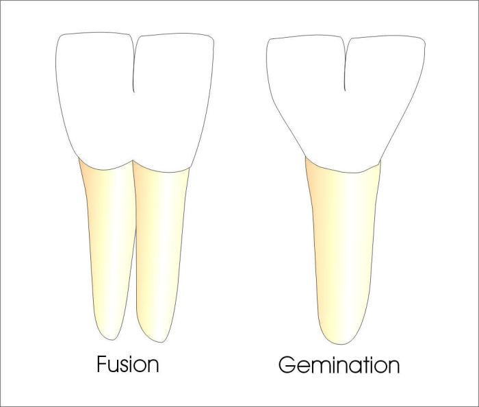 Concrescence vs fusion vs gemination