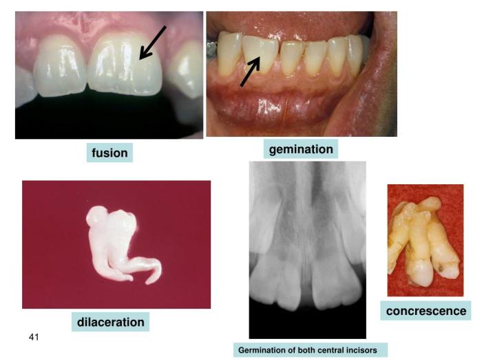 Fusion gemination dentalcare education